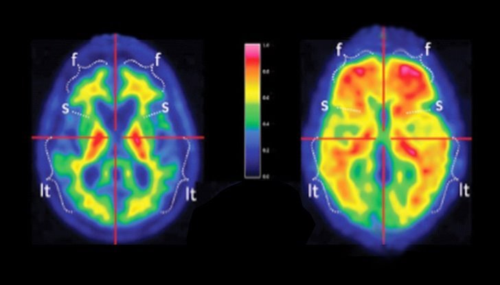 inteligencia artifical diagnostica alzheimer